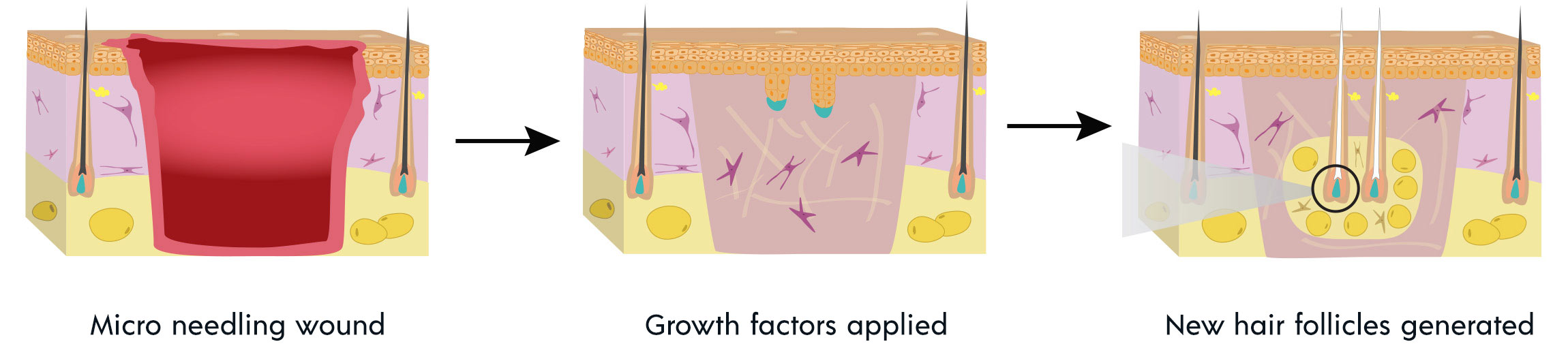 The Genius of Hair Follicle Neogenesis