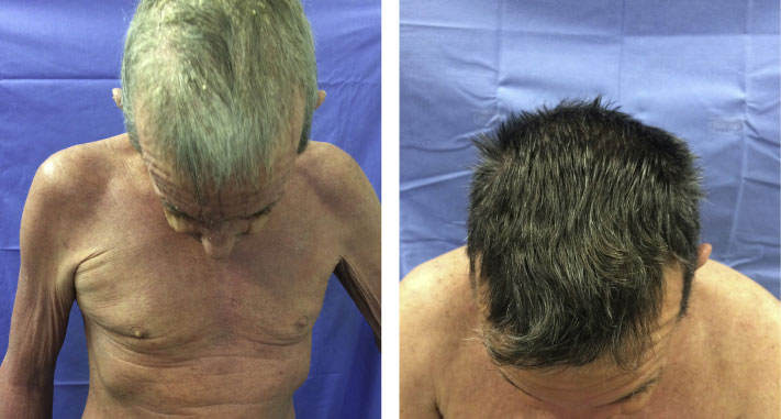 Before and after Secukinumab hair regrowth