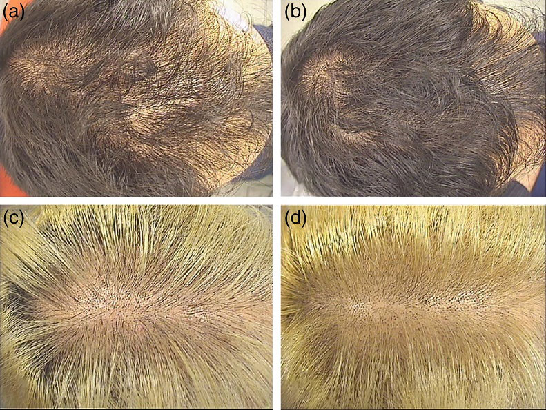 Equol for hair loss study results