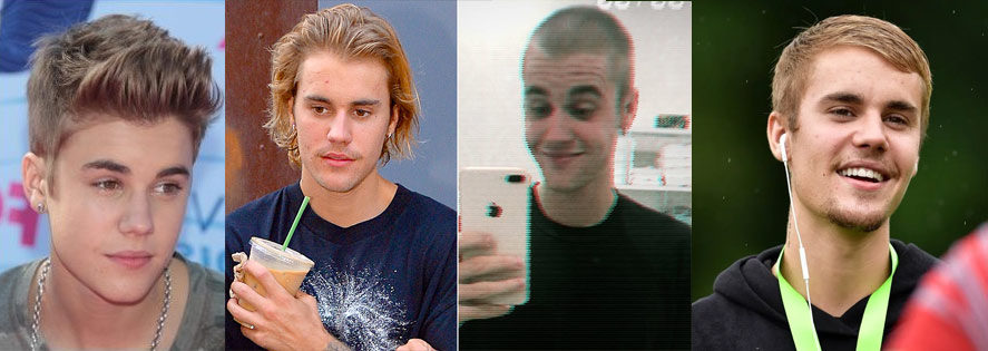 Justin Beiber hair loss