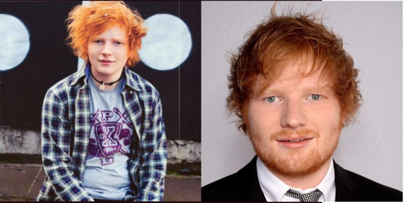 Ed Sheeran young and old hair loss