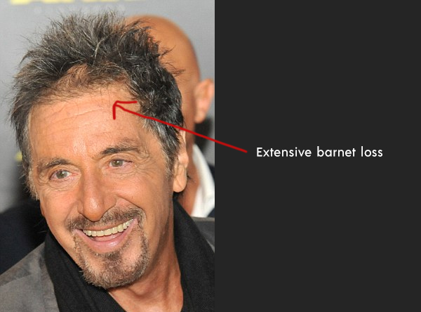 Al Pacino hair loss